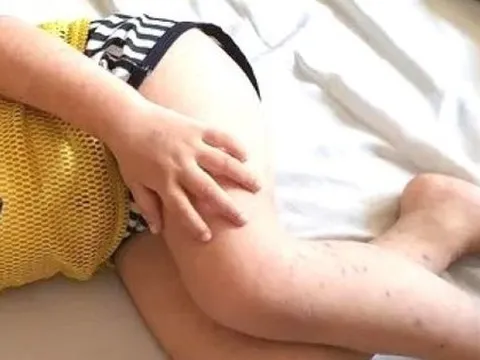 Bình Dương ghi nhận ca đầu tiên mắc tay chân miệng tử vong