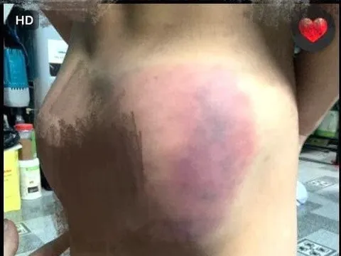 Phụ huynh ở Tp.Nha Trang tố người dạy trẻ đánh cháu bé bị thương