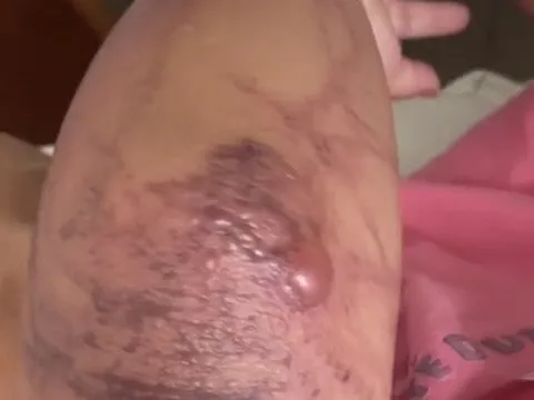 Từ vụ bé gái tím tái, mất ý thức khi bị sứa biển đốt: Bác sĩ hướng dẫn xử trí để tránh hậu quả đáng tiếc