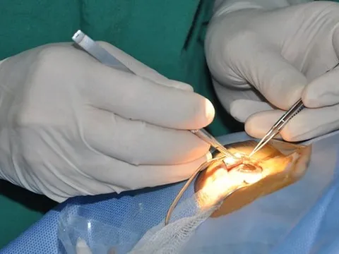 Vì sao hàng trăm người hiến giác mạc nhưng bệnh viện không thể tiếp nhận?