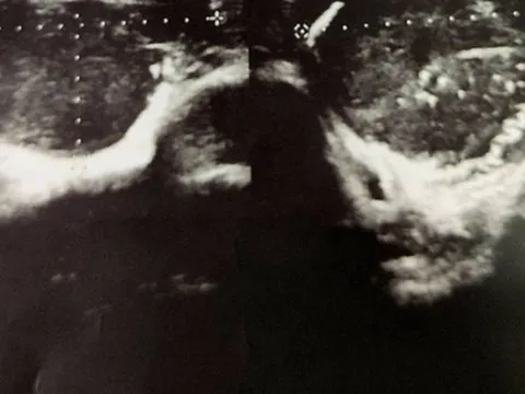 Người đàn ông 39 tuổi bị ung thư tinh hoàn và cảnh báo từ bác sĩ