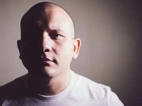 Đột phá: Trị dứt hói đầu nhờ... nốt ruồi