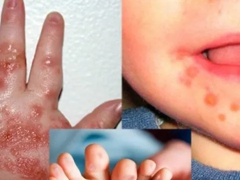 EV71 gây bệnh tay chân miệng nguy hiểm thế nào?