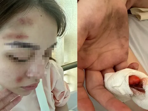 Một cảnh sát hình sự bị bạn gái "tố" hành hung gây thương tích