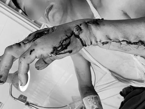 Người đàn ông ở Đồng Nai bị máy cưa đá ăn luôn cánh tay