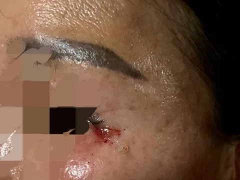 Huế: Làm rõ sự việc sau 8 tháng cắt mí mắt vẫn còn sót lại chỉ khâu