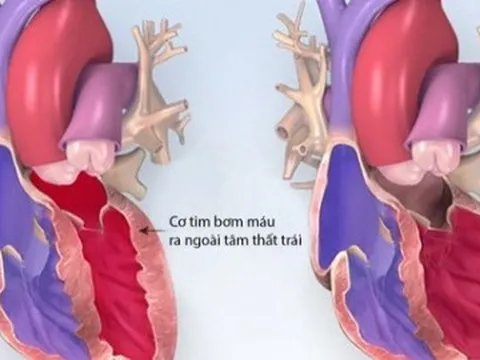 Bé 1 tuổi bị cao huyết áp