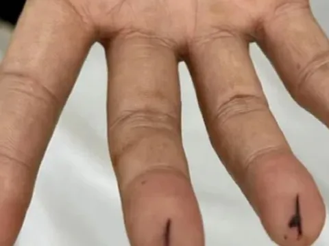 Nặn máu độc chữa đột quỵ, người đàn ông nguy kịch