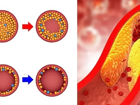 6 gạch đầu dòng cần nhớ để phòng ngừa mỡ máu cao ở tuổi 30