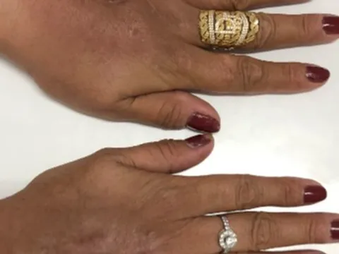 Người phụ nữ đau đớn sau 20 năm bơm silicon để được bàn tay “búp măng”