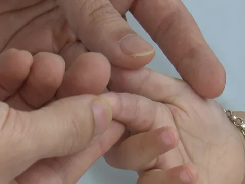 TP. Hồ Chí Minh: Số ca mắc, nhập viện do tay chân miệng tăng nhanh