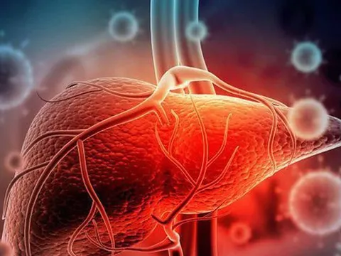 Phó Chủ tịch Hội Gan mật chỉ ra thủ phạm âm thầm “đục đẽo” lá gan tới xơ hỏng