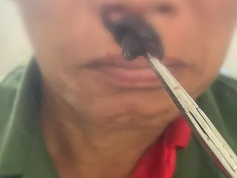 Đỉa làm tổ trong mũi người đàn ông ở Hà Giang