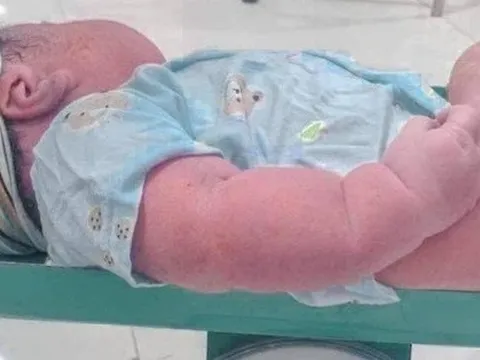 Sản phụ Nghệ An sinh thường con thứ 6 là bé trai nặng 5kg