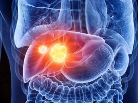 2 yếu tố khiến tỷ lệ tử vong do ung thư gan tăng vọt tại Anh: Nhiều người Việt cũng có 2 điểm này