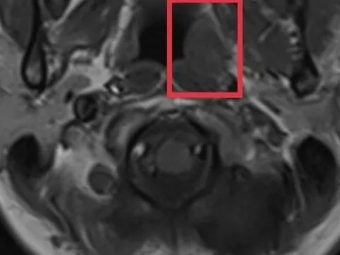 Cẩn trọng với loại ung thư nguy hiểm nhưng có triệu chứng mơ hồ