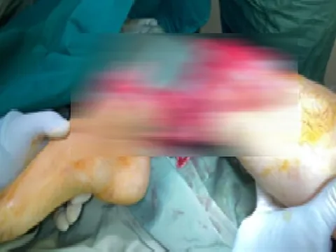 Hơn 5 giờ phẫu thuật nối thành công bàn chân nam thanh niên bị đứt lìa