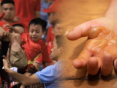 Từ vụ bé trai bị bỏng do pháo sáng trên sân Hàng Đẫy: Bác sĩ lưu ý khi xử trí vết bỏng