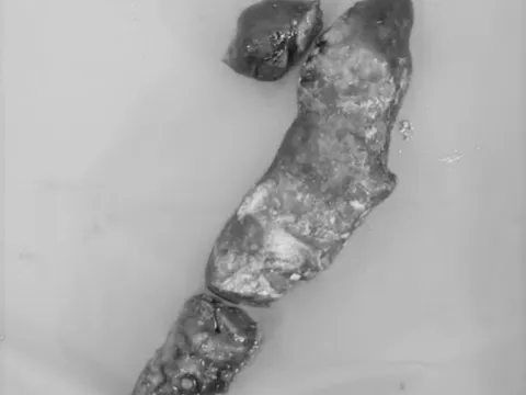 Viên sỏi “hình cây” trong đường mật người đàn ông