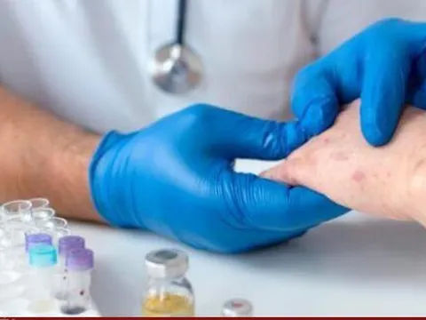 Bệnh phong lan rộng tại Mexico