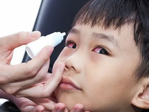 Dịch đau mắt đỏ vào mùa, bé có 5 dấu hiệu sau cha mẹ cần cho con đi khám ngay