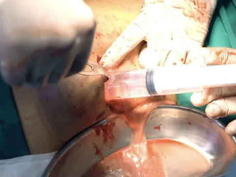 Cảnh báo biến chứng do làm đẹp tại cơ sở không phép