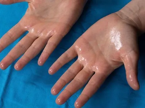 Mùa hè, cơ thể ra nhiều mồ hôi có phải là thải độc tốt hơn hay không?