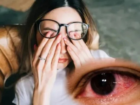 Chuyên gia chỉ rõ nguyên nhân khiến nhiều người bị đau mắt đỏ trong thời điểm hiện tại