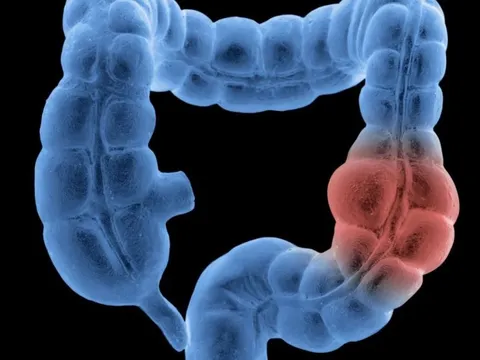 Thói quen xấu khiến nguy cơ mắc ung thư đại tràng tăng vọt: Nhiều người có mà không biết