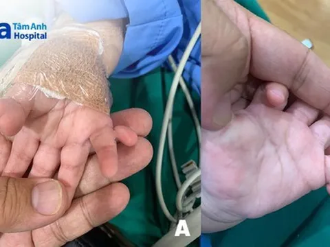Bé gái sinh ra khác thường với 24 ngón tay, chân