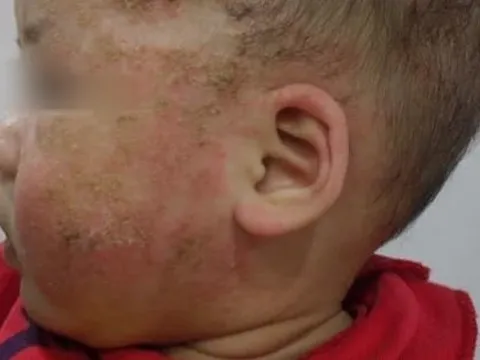 Trị viêm da cơ địa bằng tắm lá, bé 8 tháng tuổi biến chứng nặng