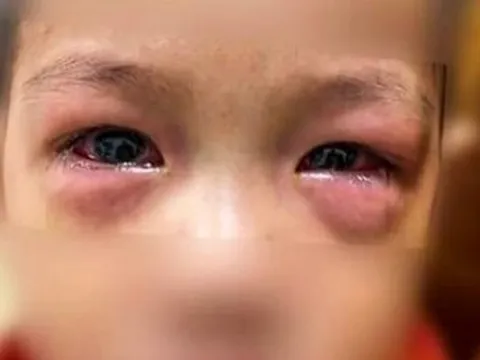 Dịch đau mắt đỏ gia tăng và những điều cần lưu ý