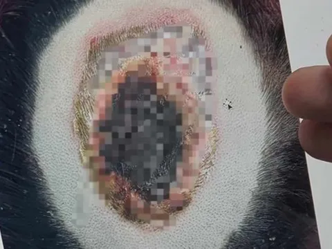 Tẩy tóc khiến cả mảng da đầu cô gái trẻ loét, chảy mủ