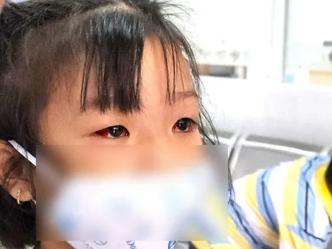 Bệnh viện Nhi đồng 2: Hàng chục ca đau mắt đỏ đến khám mỗi ngày