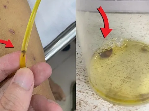 Hy hữu: Sán theo ống dẫn lưu đường mật ra ngoài, 'thủ phạm' đến từ món nhiều người thích