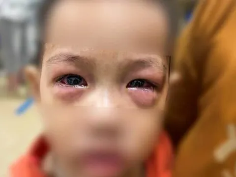 Gia tăng bệnh nhân đau mắt đỏ, bác sĩ nói không cần “săn” thuốc “xịn"