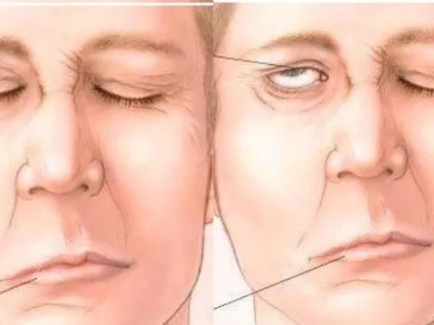 Trúng gió và đột quỵ não thường bị nhầm lẫn, phân biệt ra sao để có cách xử trí đúng?