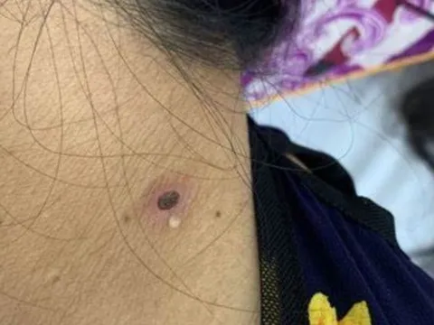 Gần 300 người ở Yên Bái mắc căn bệnh nguy hiểm, 1 ca đã tử vong