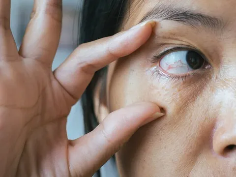 Đột quỵ mắt là gì? Dấu hiệu, nguyên nhân và cách phòng ngừa