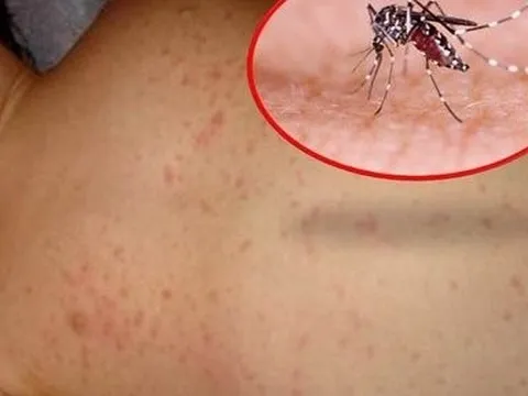 Số ca sốt xuất huyết tại Hà Nội tăng dựng đứng, lên hơn 2.000 ca/tuần