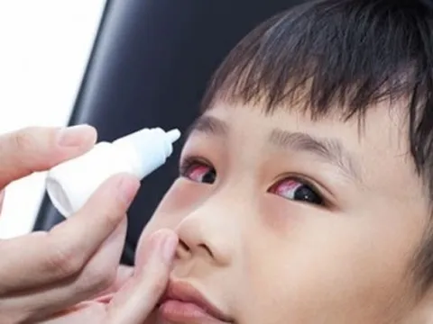 6.000 ca đau mắt đỏ, chủ yếu là trẻ em ở Quảng Bình