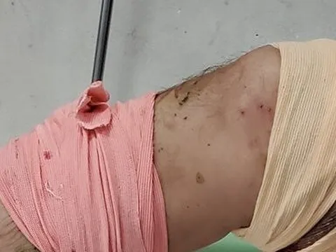 Đồng Nai: Bị khỉ nhà nuôi cắn, người đàn ông nhập viện cấp cứu