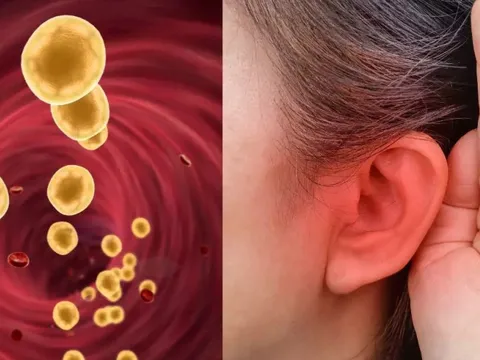 Khi mỡ máu tăng cao, tai sẽ phát ra 3 “tín hiệu” cảnh báo đỏ