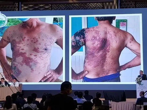 Những dấu hiệu trên da cảnh báo bệnh lý ác tính