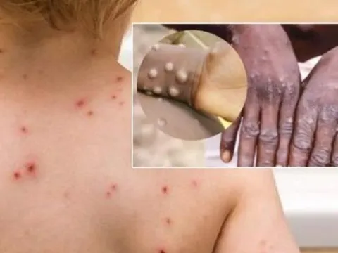 Có 8 người tại Tp.HCM theo dõi sức khỏe do tiếp xúc gần ca đậu mùa khỉ