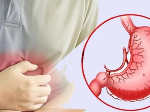 Bé trai thủng dạ dày do vi khuẩn HP, bác sĩ khuyến cáo những việc cần thay đổi trong gia đình để phòng bệnh