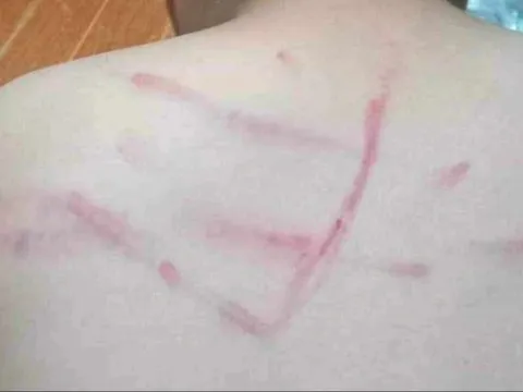 Không làm bài tập, học sinh lớp 4 ở Thanh Hóa bị cô giáo đánh lằn lưng