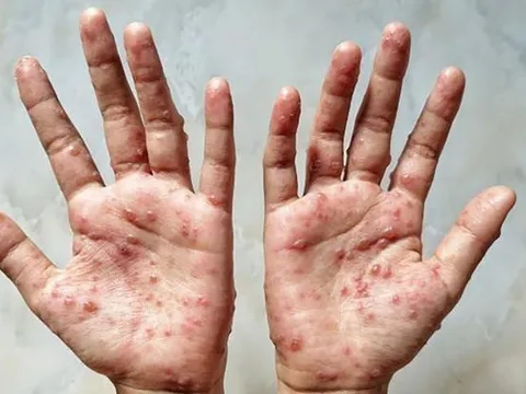 Phát hiện thêm 1 trường hợp mắc đậu mùa khỉ tại TP. Hồ Chí Minh