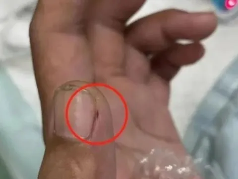 Bị viêm màng não nguy kịch vì cách sơ chế thịt lợn sai nhiều người mắc