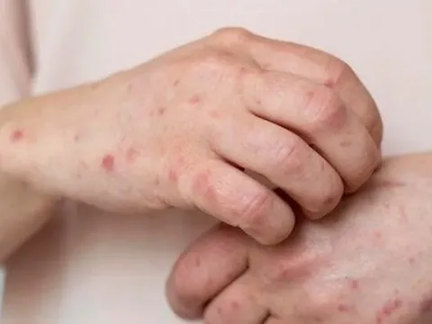 "Đậu mùa khỉ xâm nhập vào Việt Nam là khó tránh khỏi"